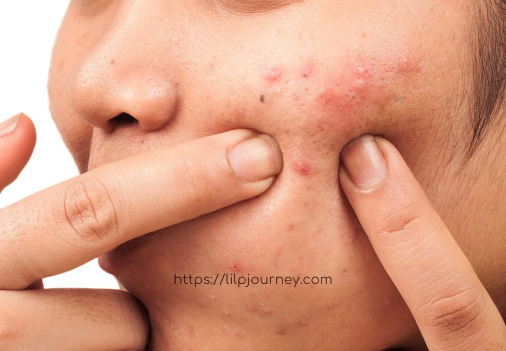 solusi mengatasi jerawat